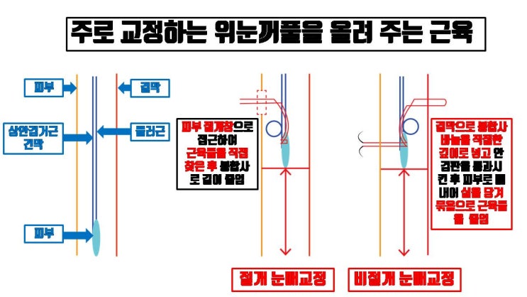  절개 눈매교정과 비절개 눈매교정을 선택할 때 반드시 알아야 할 차이 세 가지