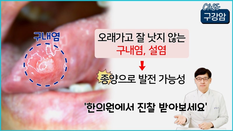 혀 밑에 뭐가 생겼는데 혹시 설암인가요? 구강암 초기증상 알아보기 : 네이버 블로그
