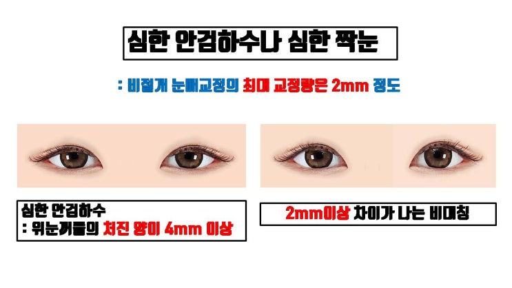  비절개눈매교정을 하면 절대 안 되는 반드시 절개눈매교정을 해야 하는 경우 3가지