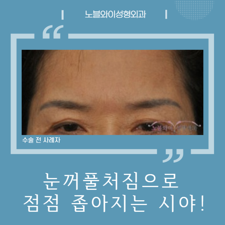  이마눈썹거상술비용 효과 보면 놀래