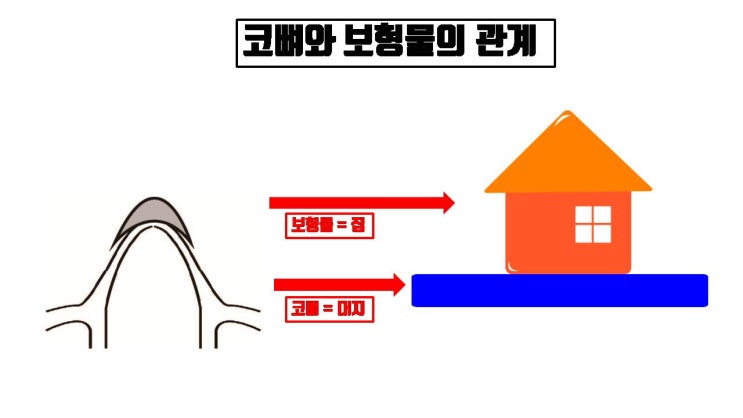  코뼈 절골 수술과 동시에 코성형, 코수술 모래 위에 집 짓기와 같아요.