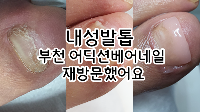  내성발톱 부천 어딕션네일 재방문했어요