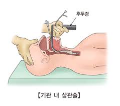  간호술기 기관내관 기관절개술 적응증순서부작용 무균술교환 흡인중재