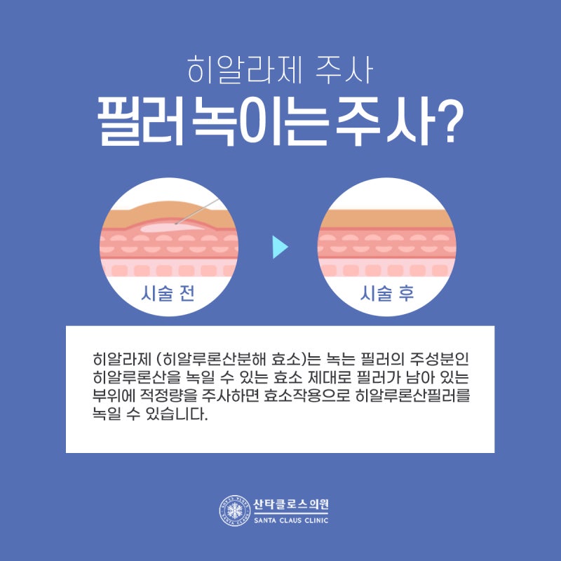 필러를 녹이는 주사비용이 걱정되시는 분들에게