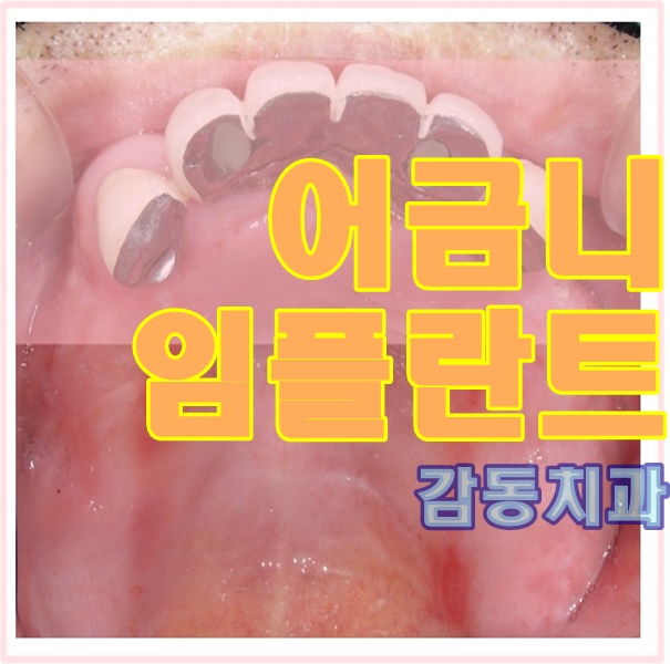  당감동치과 어금니 임플란트
