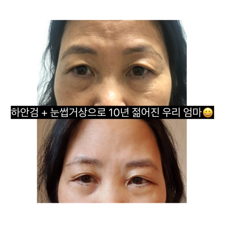  부모님 하안검수술 + 눈썹하거상술 리얼 후기 [당일~2주차]