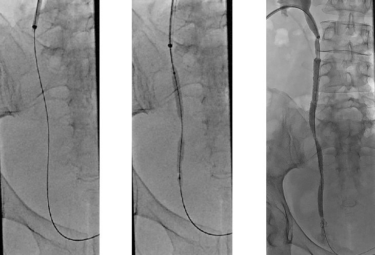 PCN(Percutaneous Nephrostomy;경피적 신루술), D-J Stent insertion(Double J ...