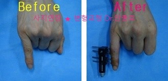  마디가 짧은 손가락 단지증