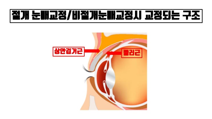  눈매교정 재수술은 반드시 첫 번째 눈매교정과 같은 수술 방법으로 해야 한다?