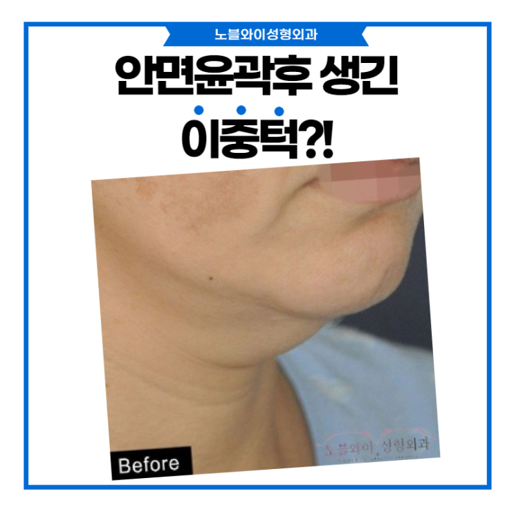  노블와이성형외과 이중턱수술 안면윤곽후 생긴 턱살