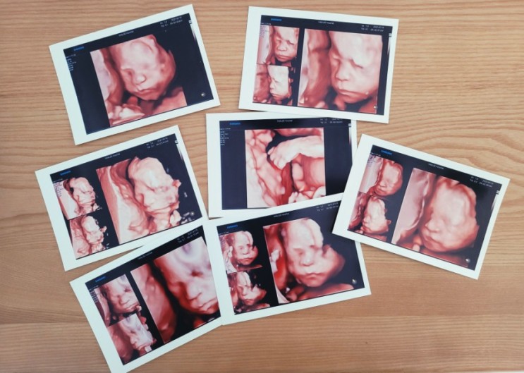 남편이 쓰는 임신일기 [12] (임신 24주 - 입체초음파 검사 , 임당검사)