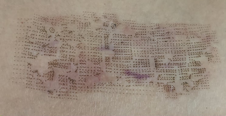  나의 켈로이드(keloid) 치료 일기 / 6개월 치료 목표 12-1 (9일차-15일차)