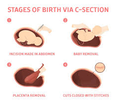  제왕절개분만적응증 cesarean section순서 분만전준비 금식마취주의사항 간호중재케이스