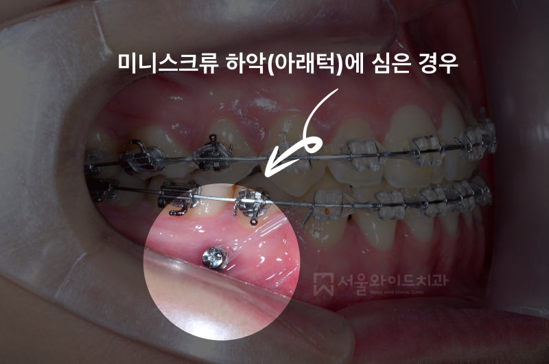 치아교정 미니스크류(miniscrew)란? 돌출입 해결과 제거, 탈락 및 통증 후기 : 네이버 블로그 치아교정 미니스크류(Miniscrew)란? 돌출입 해결과 제거, 탈락 및 통증 후기 : 네이버 블로그