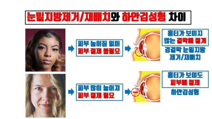  누구나 눈밑지방재배치를 할 수 있는 거 아니에요. 반드시 하안검수술을 해야 하는 경우도 많아요.