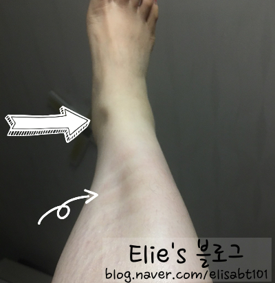  nephrotic syndrome  신증후군ㅣ minimal change nephrotic syndrome 미세변화성 신증후군