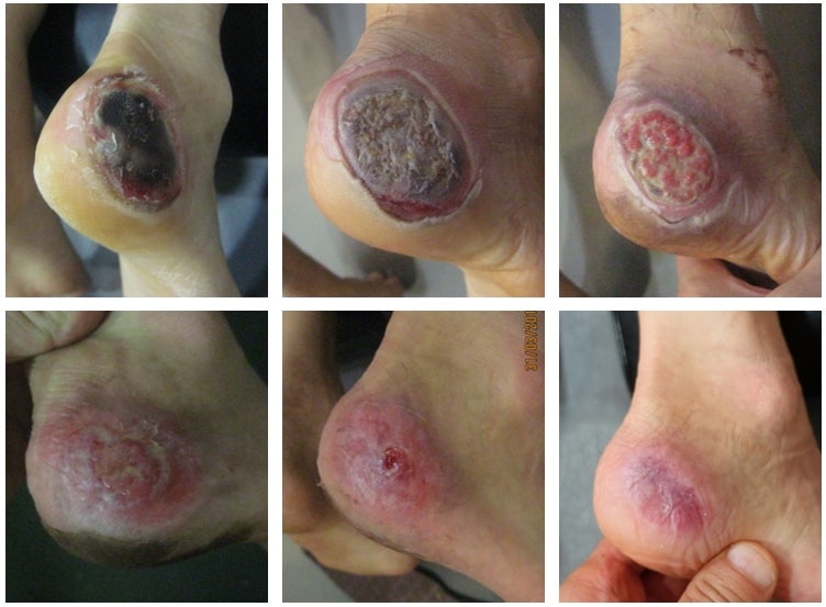 3도 화상 흉터 관리(정말 한 번도 안 되지만)는 계속 노력해야 할 것 같다. 11