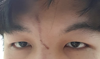 어린이 흉터 수술, 도그이어 제거 수술 국소 마취 및 낮잠 수술 리뷰 7