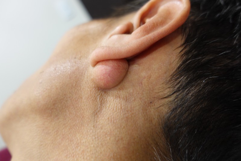 Dr.Park] 귀 뒷쪽에는 피지낭종이 잘생겨요. 제거 수술 외과 : 네이버 블로그