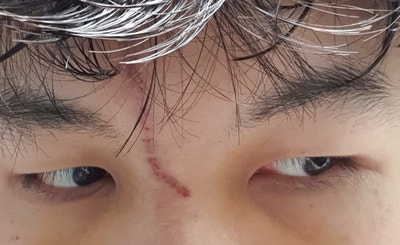 어린이 흉터 수술, 도그이어 제거 수술 국소 마취 및 낮잠 수술 리뷰 1