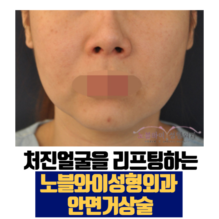  노블와이성형외과 안면거상술 제대로네요