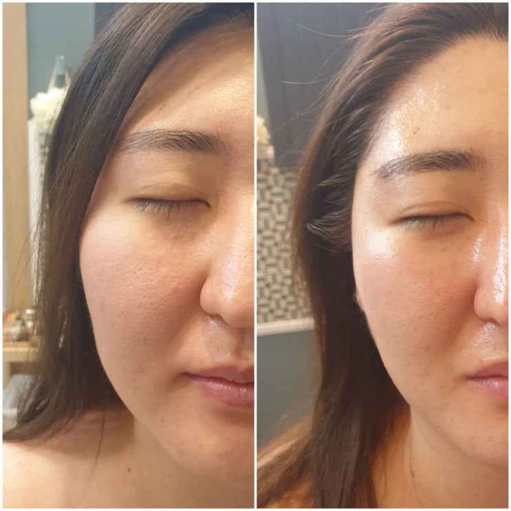  마산피부관리 팔자주름 미간 펴고 모공 쪼이고 리프팅 #내돈내산