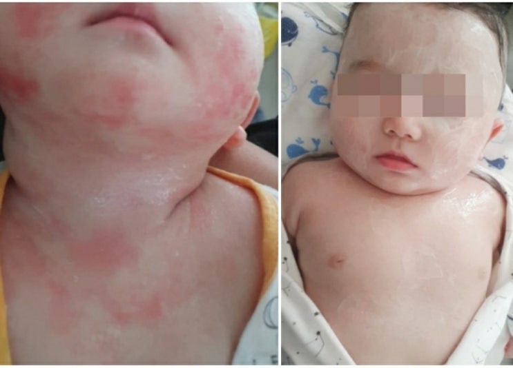  기저귀발진 크림 부작용 회복한 후기