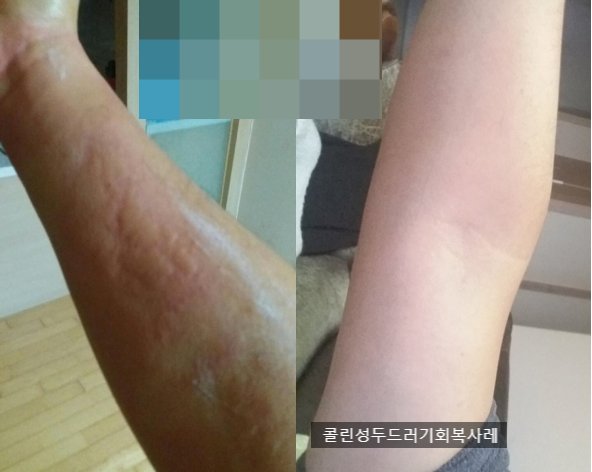  콜린성두드러기 - 갑작스러운 피부발진 잠재우는 법