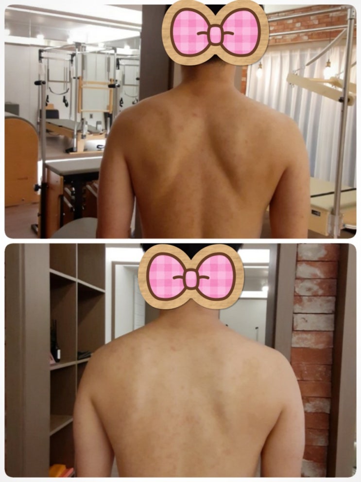  [이수역체형교정] 등과 어깨가 항상 아프다면 ? 견갑골 안정화 편