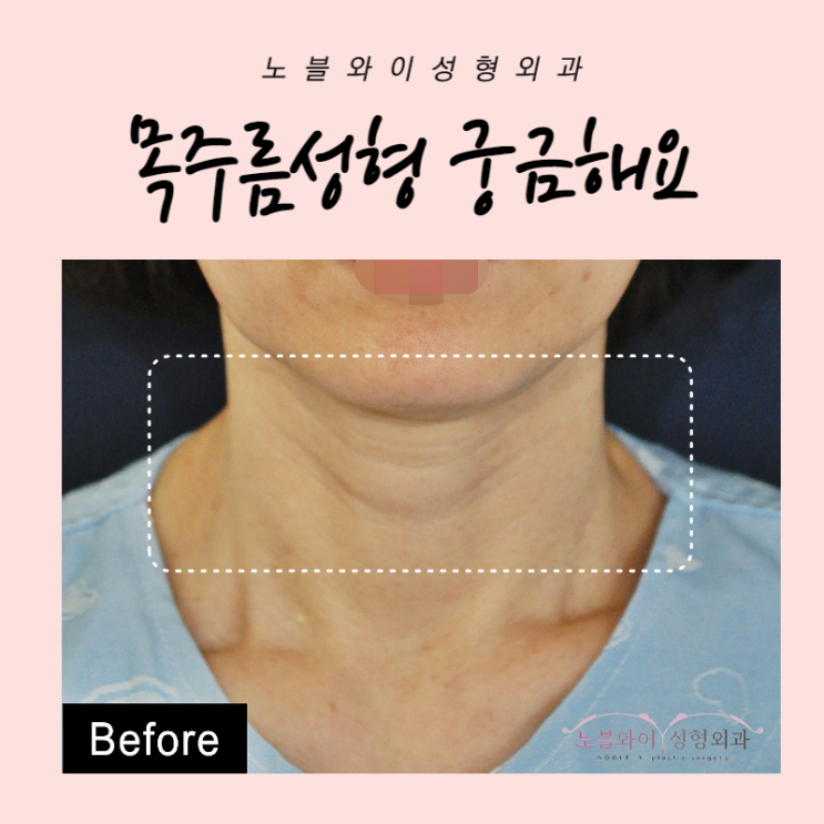  목주름성형 대해 궁금한게 있어요