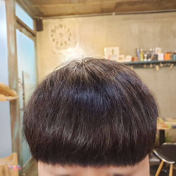  붙이는 헤어증모술로 모발이식 암흑기 해결