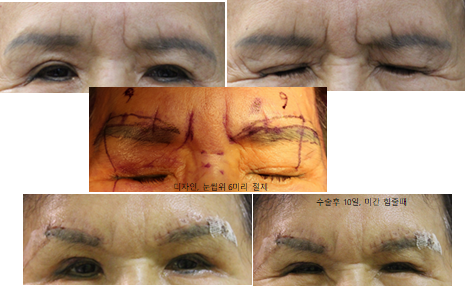 눈썹 사이 주름을 없애는 수술? 고민이라면 지금 홈케어를 즐겨보세요!