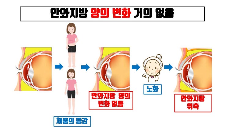  안와지방은 체중이 늘든 줄든 양이 변하지 않은 채 일정하다고 의사 선생님께 들었는데 사실인가요?
