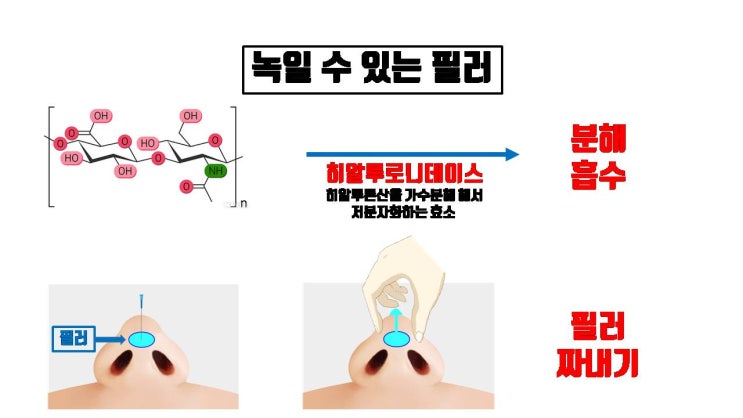  코필러 후 코수술을 할 때 필러가 코수술 결과에 분명히 나쁜 영향 줄 수 있어요!!!