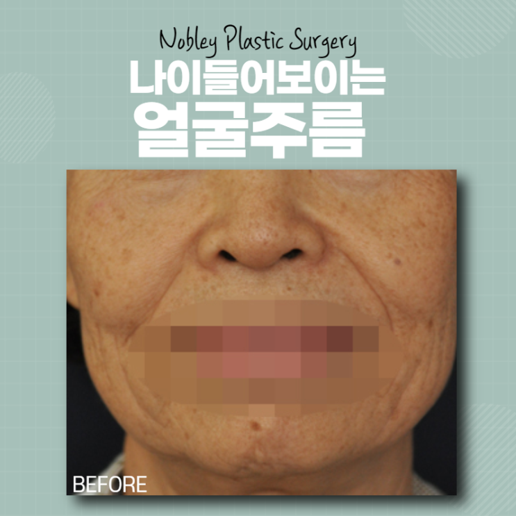  얼굴주름제거성형술 들어보셨어요?