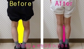  휜다리의 각변형과 회전변형