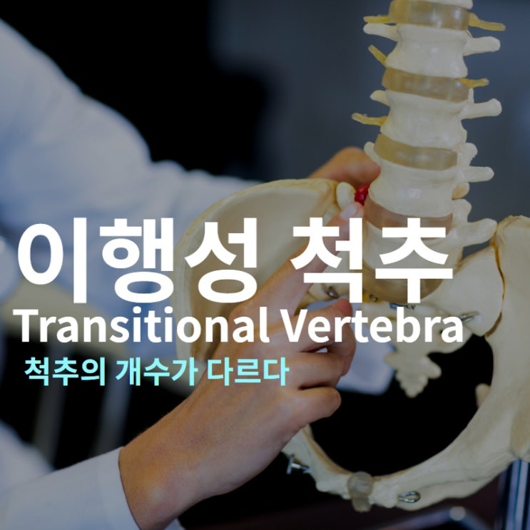  이행성 척추 : 척추의 개수가 다른 사람이 있다고요??
