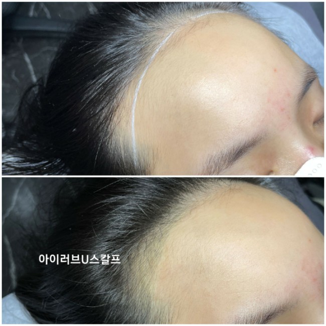  전주헤어라인 이식보다는 헤어라인교정 이 가성비갑!