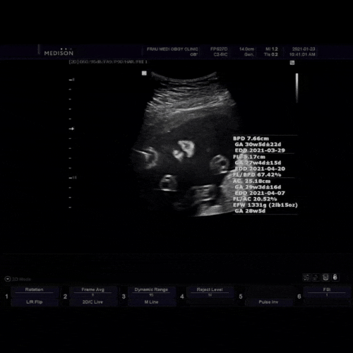  임신 28주 ( 배크기 , 태동, 입덧, 배변 외 임신 증상 기록 ) +드라이플라워 결국