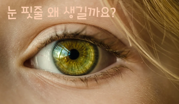  눈 핏줄터짐, 왜 그럴까요?