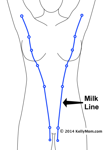 Q88. 신생아 부유방(supernumerary breast)의 원인,증상,치료