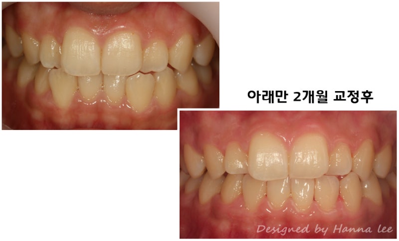 앞니부분교정 비용? 치아 다듬기10분 8