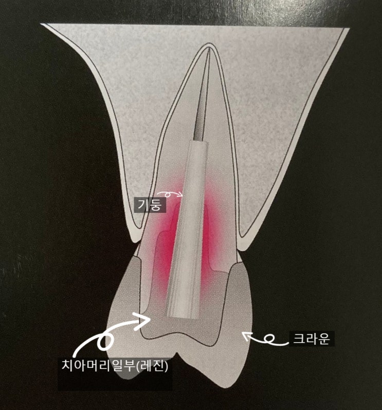  치아 신경치료 과정 : 치아에 기둥을 심어야 한다네요 _쉬운 치과이야기