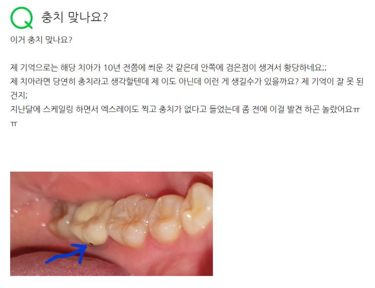 지식인 질문, 크라운 한 치아 어금니 안쪽에 충치가 생긴 것 같아요. 검은 점이 보여요 (feat. PFM crown)