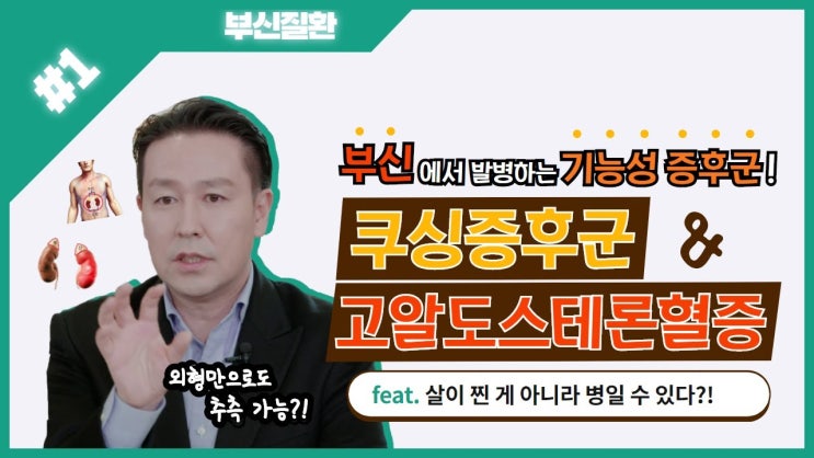 마일리지 5배 퀴즈 이벤트! 쿠싱증후군의 외형적 특징으로 가장 적절하지 않은 것은?