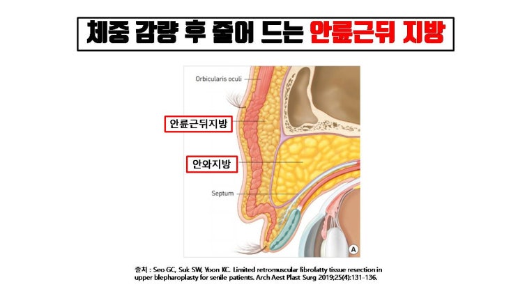  다이어트가 최고의 성형, 다이어트하면 안와지방 양은 그대로여도 쌍수는 성공!!!