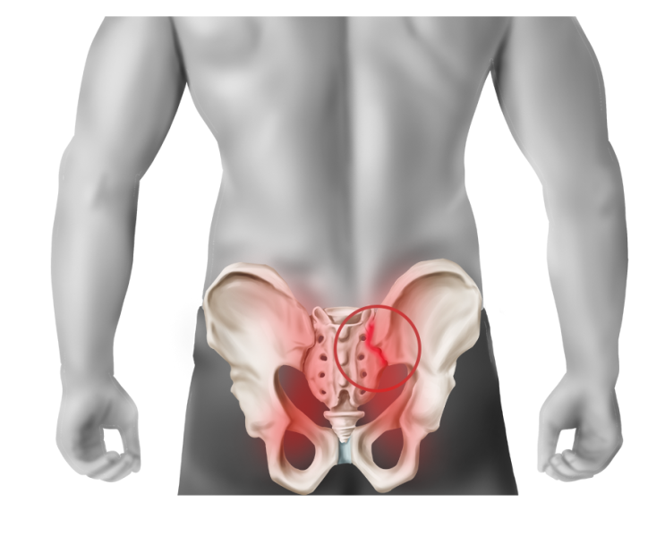  천장관절증후군, 천장관절염, 천골통증, 엉치통증, 엉치뼈통증 - 가로세로 한의원 일산점