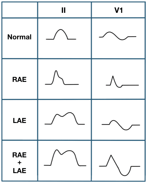 [P wave / atrial dysrhythmia ] 심방부정맥과 그에 따른 심전도의 ECG 변화/특징 : 네이버 블로그
