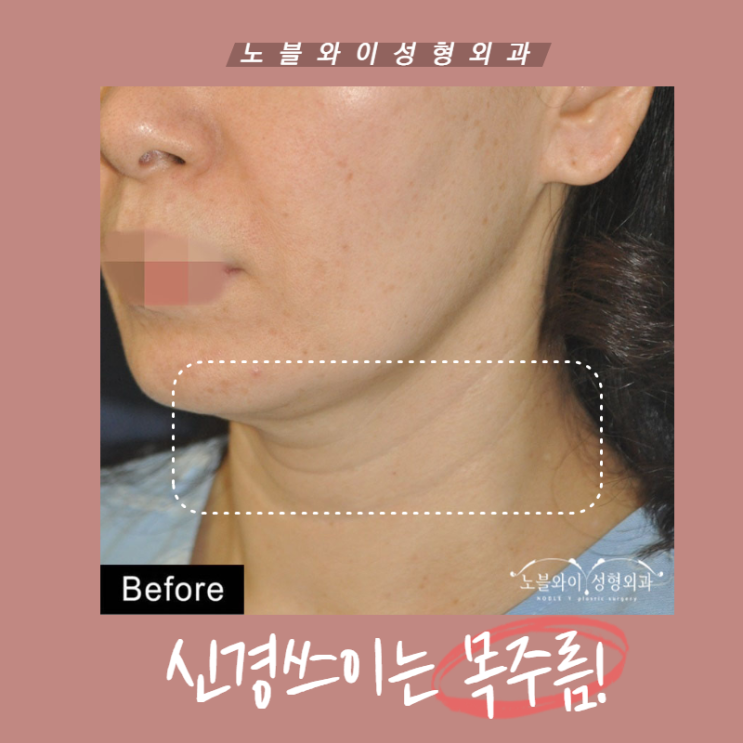  목주름거상술 둘레도 줄어들어 가녀린 목라인 겟