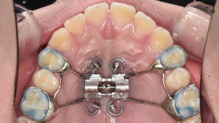 구개확장징치(상악확장장치, RPE, MARPE, MSE, RME) 할때 양치하는 방법, 잘 청소하는 방법 구개확장징치(상악확장장치, RPE, MARPE, MSE, RME) 할때 양치하는 방법, 잘 청소하는 방법